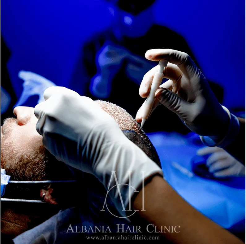 Metoda FUE: Revolucioni i Transplantimit të Flokëve