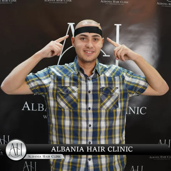 Body Hair to Head Transplant: Is It Possible?