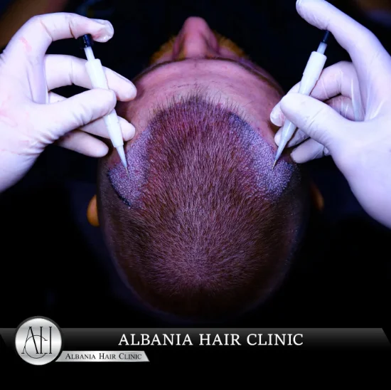 Redness and Irritation After Hair Transplant: Causes
