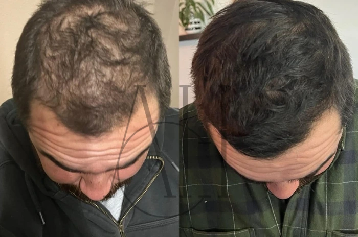 Il Minoxidil è un aiuto rapido o una soluzione a lungo termine?