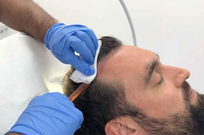 Platelet-Rich Plasma (PRP) Therapy Potential Side Effects