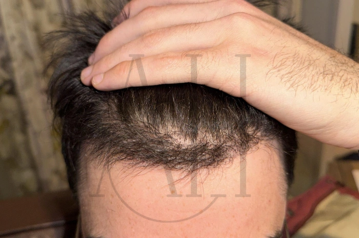Hair transplant myths