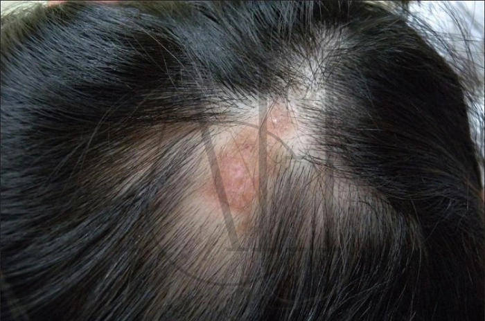 Lupus hair loss causes symptoms and treatment options