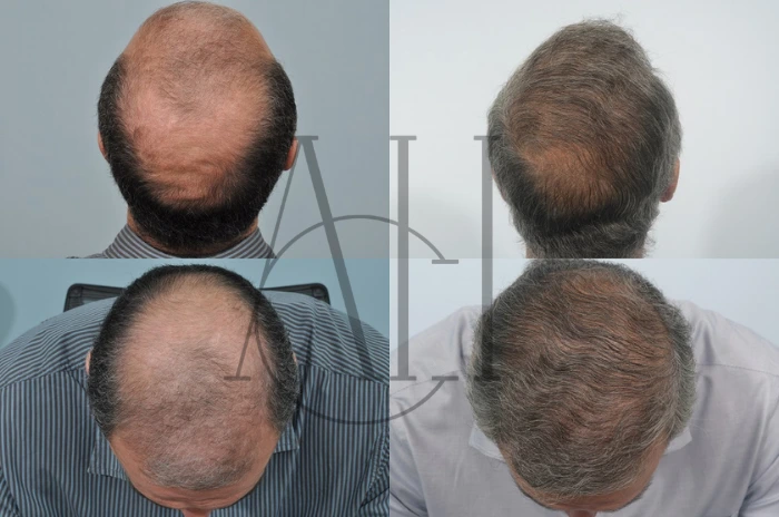 Hair Transplant Last