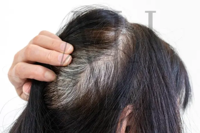 Does Stress Cause Hair to Turn Gray