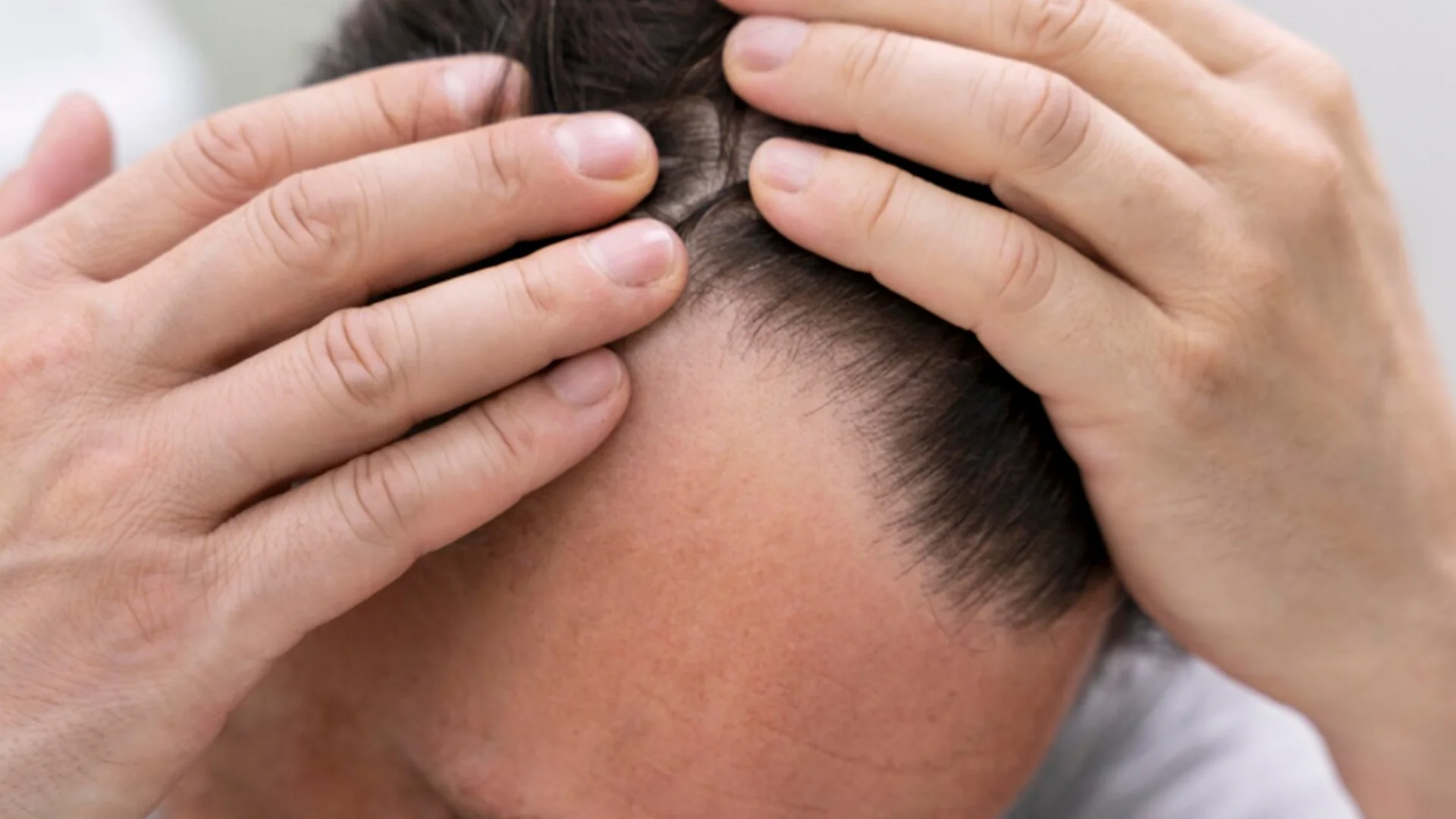 how-is-dhi-hair-transplantation