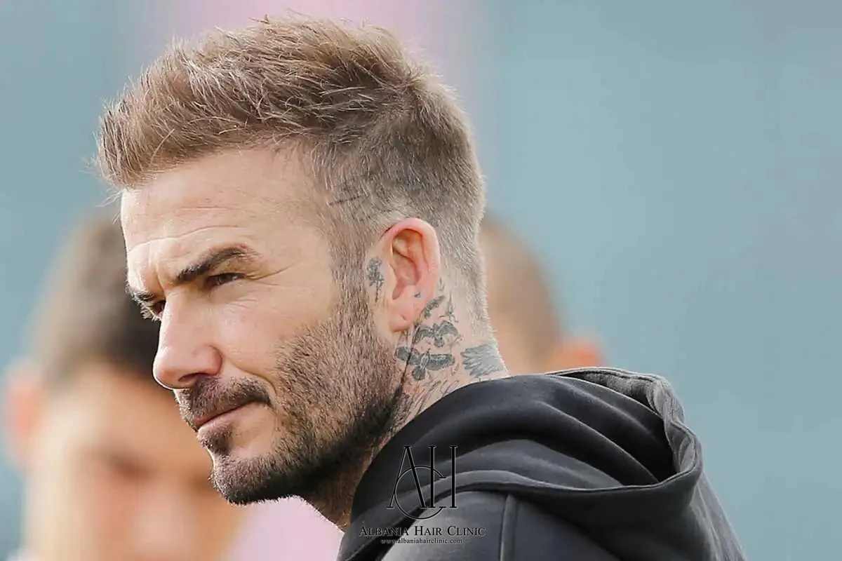 David Beckham’s Hair Transplant