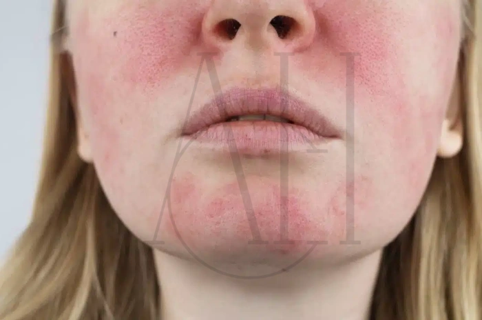 PRP cost and side effects