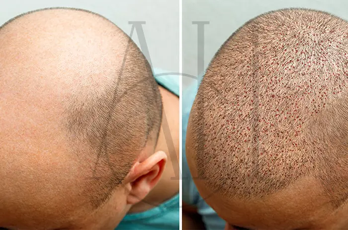 What Does Fist Size Mean in FUE Hair Transplantation_
