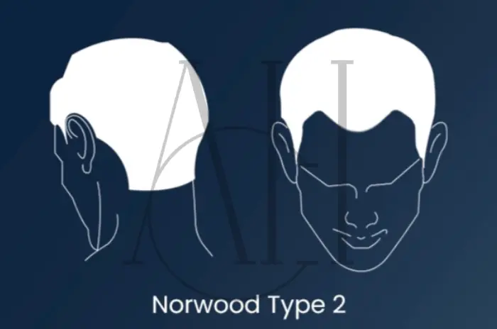 Norwood 2 medications transplant options and results