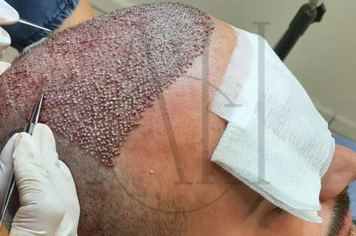 What is the Meaning of Fist Size in FUE Hair Transplantation and After the Transplantation_