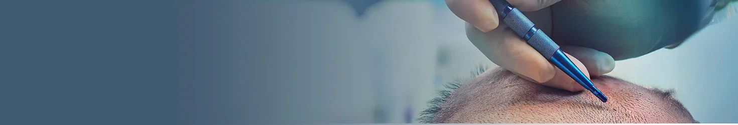 Transplanti i Flokëve Sapphire FUE në Shqipëri