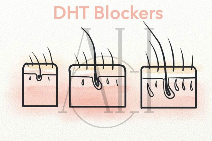 DHT and hair loss