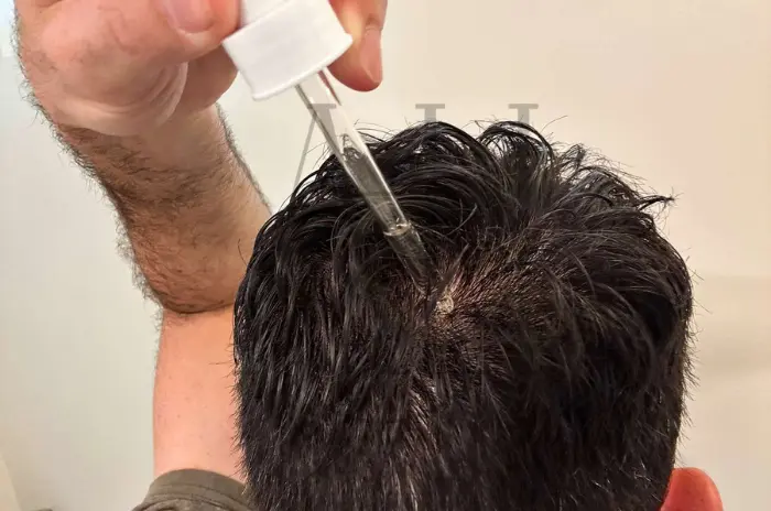 A mund të trajtojnë serumet e rritjes së flokëve rënien e flokëve?