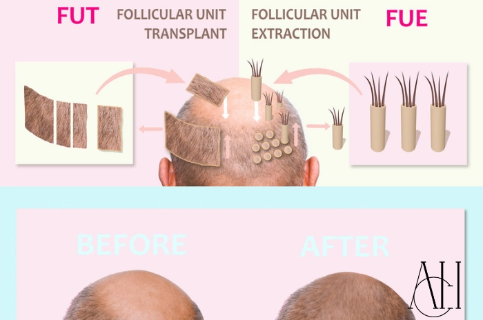 differences between sapphire fue and dhi