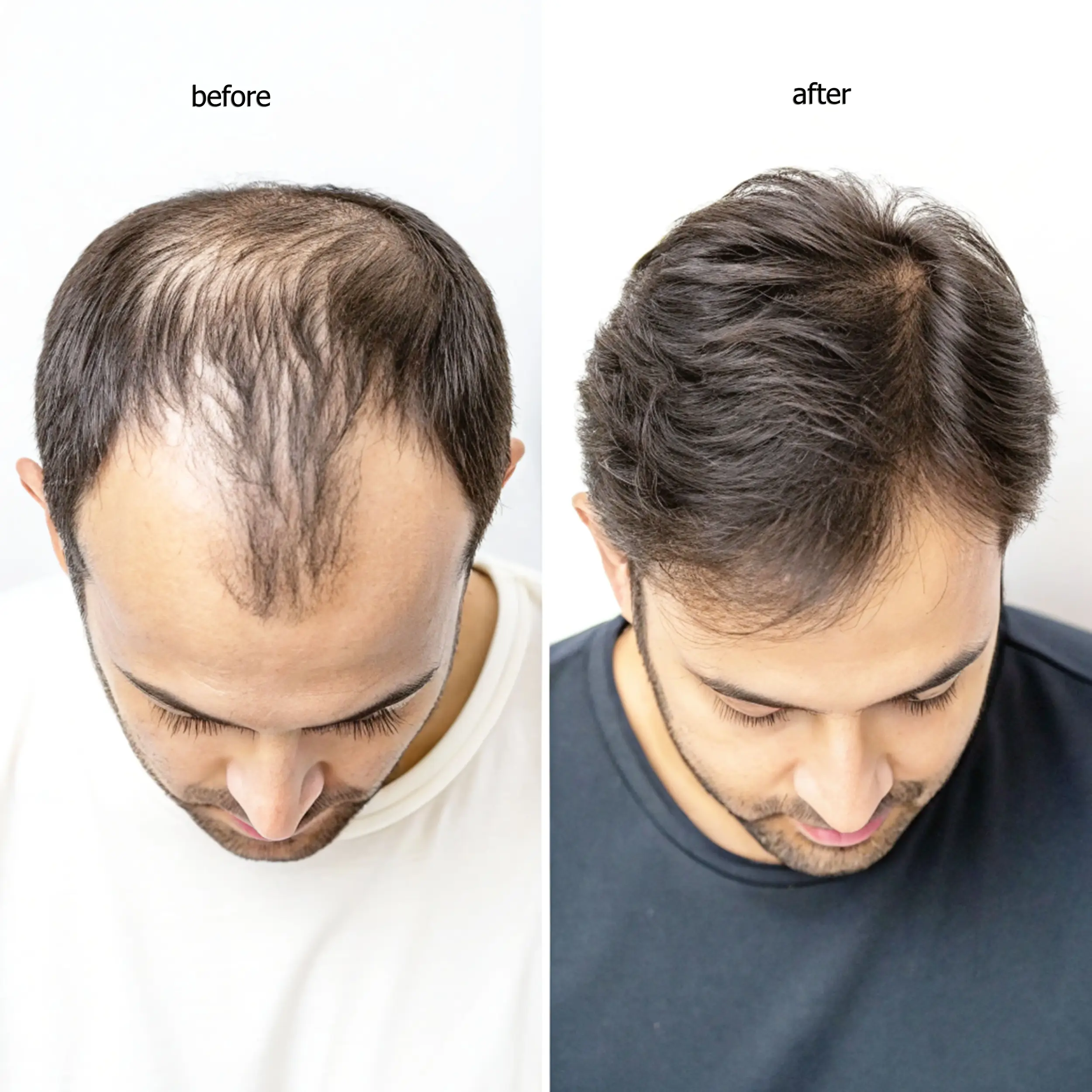 dhi-hair-transplant