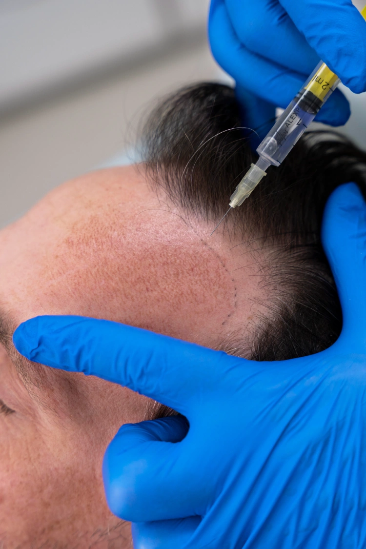 La tecnica del trapianto di capelli con zaffiro è dolorosa?